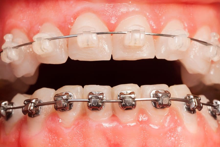 Orthodontics - Braces and Aligners